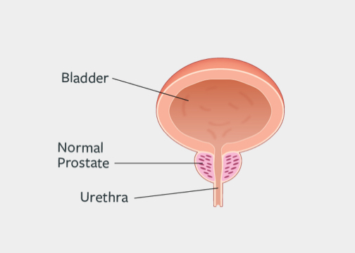 Benign Prostatic Hyperplasia (BPH) Causes | Aquablation® Therapy