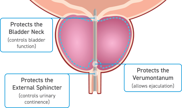 An illustration of the prostate gland, highlighting bladder neck, external sphincter, and verumontanum with their functions.
