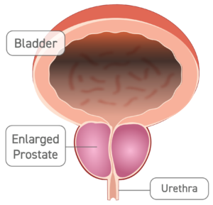 A diagram of the bladder, urethra, and an enlarged prostate.